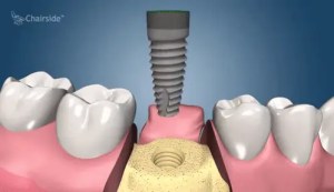 Dentist near me, dentista cerca de mi, best dentist miami, mejor dentista miami, pizza near me, chinese near me, food near me, crown dentist miami, cheapest dentist miami, root canal dentist miami, cheapest root canal miami
